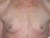 Patient # 10776 Before Photo # 1